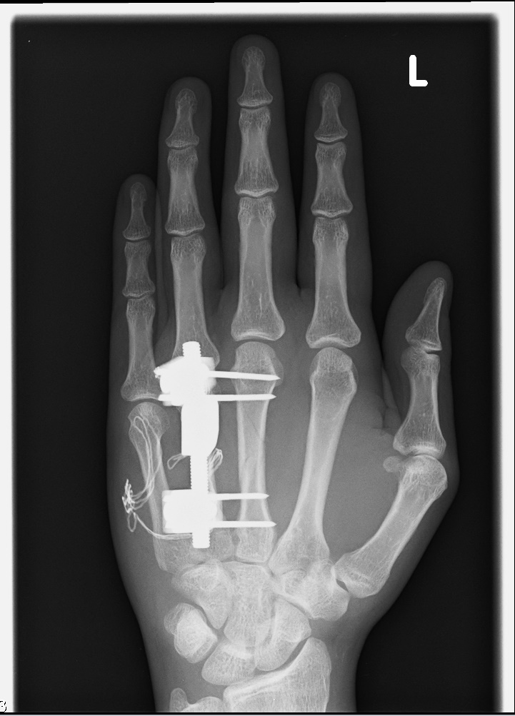 Как определить трещину в кости. Остеосинтез основной фаланги пальца кисти. Перелом средней фаланги пальца.